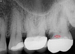 Can an X-ray Show a Cavity Under a Crown? And Why Do Dentists Love Puzzles?