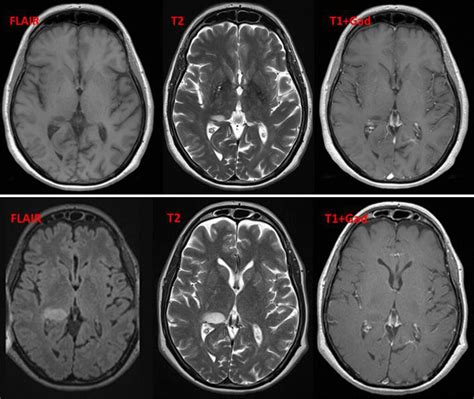 Does MS Show Up on CT Scan? Exploring the Intersection of Technology and Human Perception