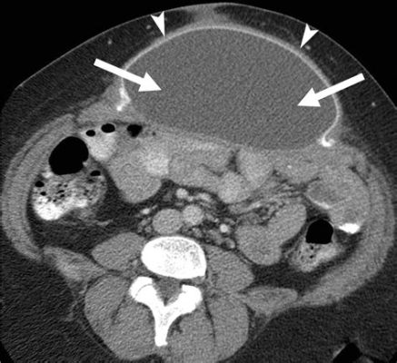 Will a CT Scan Show a Hernia? Exploring the Intersection of Medical Imaging and Mystical Beliefs